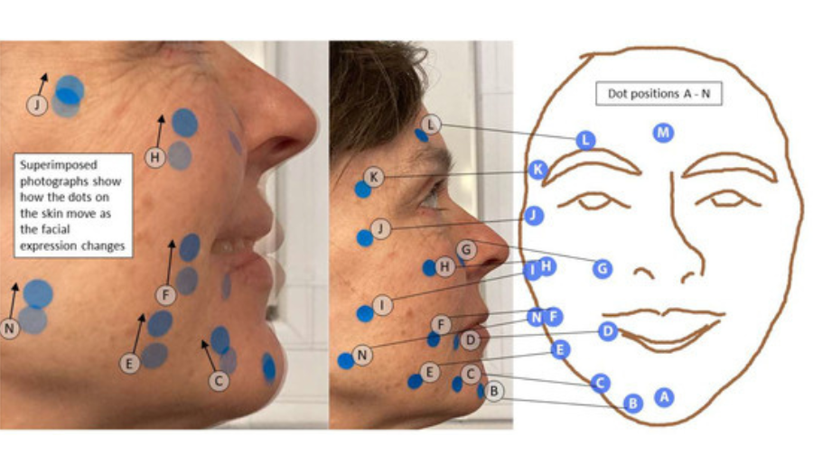 Showing sticky dots applied to volunteer’s face to help measure movement of facial muscles